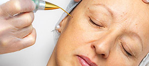 Warts Treatment Specialist Near Me in Miami, FL
