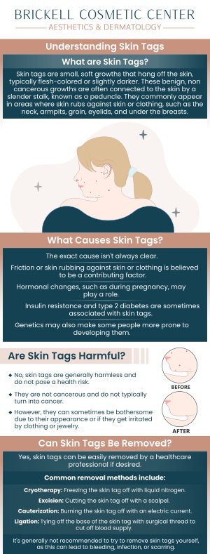Common questions asked by Clients: What are skin tags? What causes skin tags? Are skin tags harmful? Can skin tags be removed? For more information, contact us or request an appointment online. We serve patients from Miami FL, Key Biscayne FL, Wynwood FL, Coconut Grove FL, South Miami FL, Coral Gables FL, and surrounding areas.