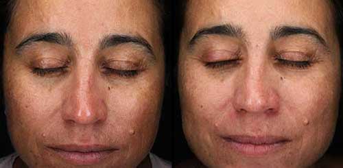 Chemical Peels at Brickell Cosmetic Center in Miami, FL