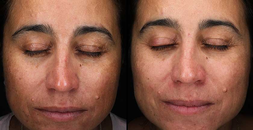 Chemical Peels at Brickell Cosmetic Center in Miami, FL