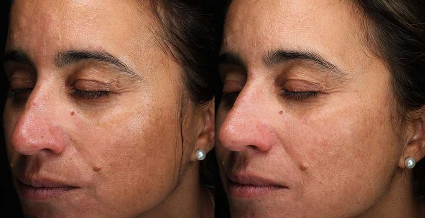 Chemical Peels at Brickell Cosmetic Center in Miami, FL