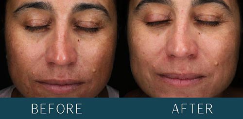 Skin Improvements at Brickell Cosmetic Center in Miami, FL