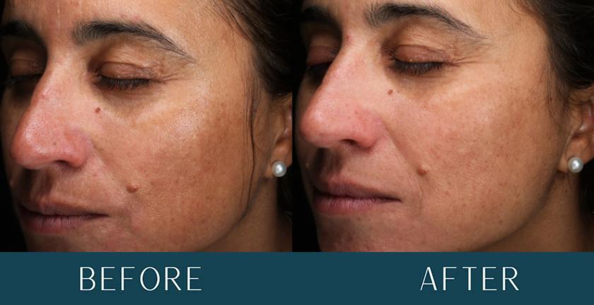 Skin Improvements at Brickell Cosmetic Center in Miami, FL