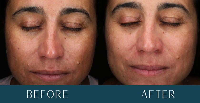 Skin Improvements at Brickell Cosmetic Center in Miami, FL