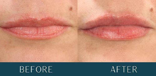 Lip Filler Enhancement at Brickell Cosmetic Center in Miami, FL Lip Filler Enhancement at Brickell Cosmetic Center in Miami, FL