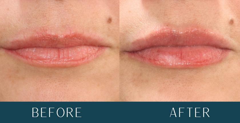 Lip Filler Enhancement at Brickell Cosmetic Center in Miami, FL Lip Filler Enhancement at Brickell Cosmetic Center in Miami, FL