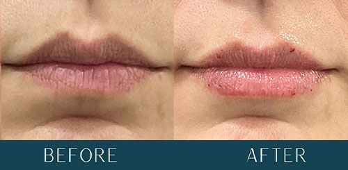 Lip Filler Enhancement at Brickell Cosmetic Center in Miami, FL