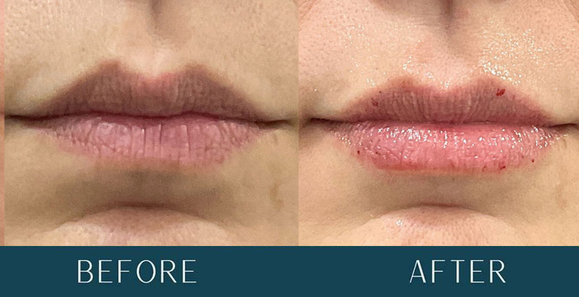 Lip Filler Enhancement at Brickell Cosmetic Center in Miami, FL