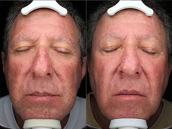 IPL for Rosacea at Brickell Cosmetic Center in Miami, FL