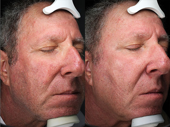 IPL for Rosacea at Brickell Cosmetic Center in Miami, FL