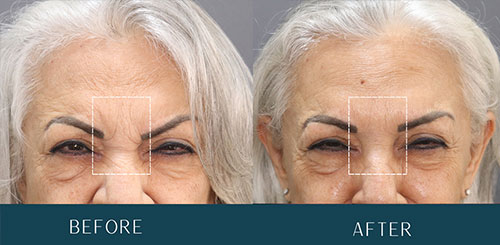 Botox Rejuvenation at Brickell Cosmetic Center in Miami, FL