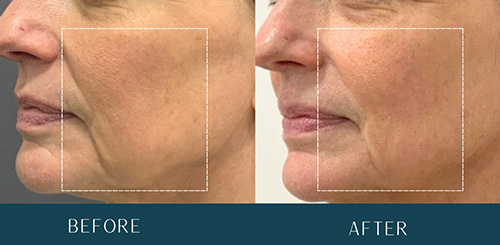 Morpheus8 Treatment Before and After Results at Brickell Cosmetic Center in Miami, FL Morpheus8 Treatment Before and After Results at Brickell Cosmetic Center in Miami, FL