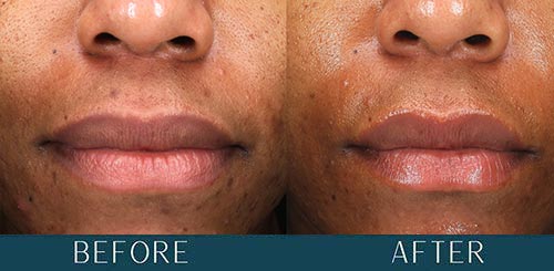 Acne & Acne Scarring at Brickell Cosmetic Center in Miami, FL Acne & Acne Scarring at Brickell Cosmetic Center in Miami, FL