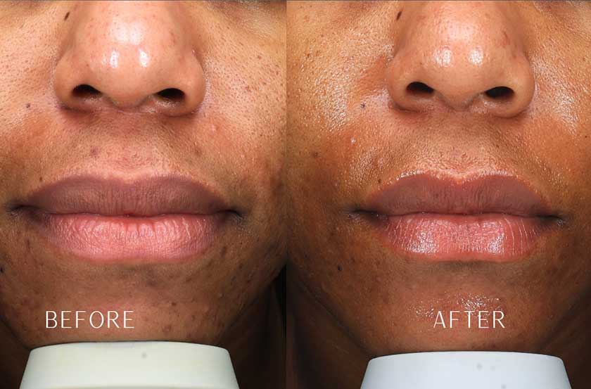 Acne & Acne Scarring at Brickell Cosmetic Center in Miami, FL Acne & Acne Scarring at Brickell Cosmetic Center in Miami, FL