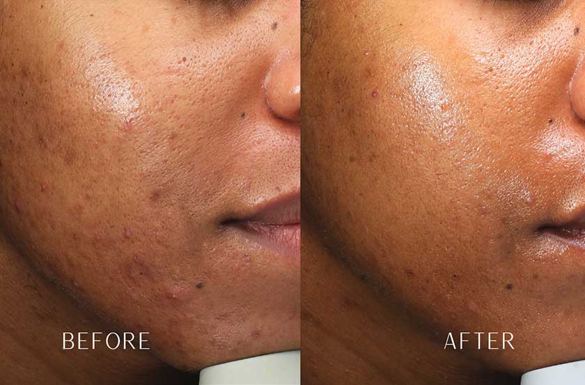 Acne & Acne Scarring at Brickell Cosmetic Center in Miami, FL Acne & Acne Scarring at Brickell Cosmetic Center in Miami, FL