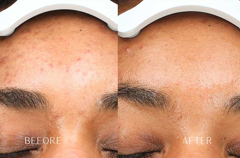 Acne & Acne Scarring at Brickell Cosmetic Center in Miami, FL Acne & Acne Scarring at Brickell Cosmetic Center in Miami, FL