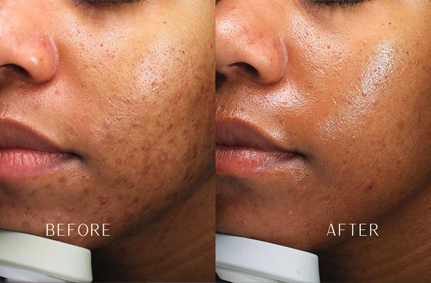 Acne & Acne Scarring at Brickell Cosmetic Center in Miami, FL Acne & Acne Scarring at Brickell Cosmetic Center in Miami, FL