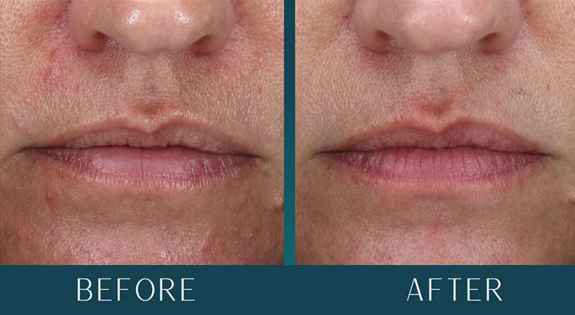 Hormonal Acne at Brickell Cosmetic Center in Miami, FL