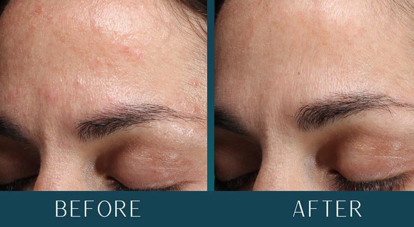 Hormonal Acne at Brickell Cosmetic Center in Miami, FL
