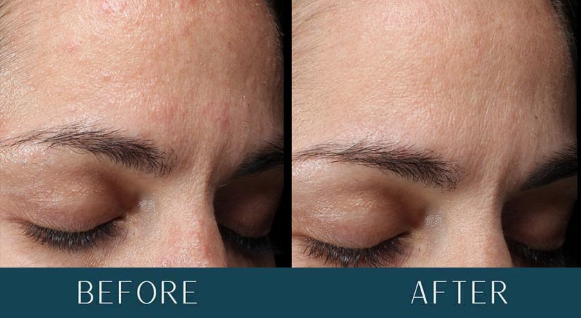 Hormonal Acne at Brickell Cosmetic Center in Miami, FL