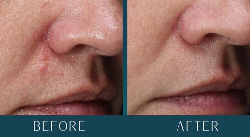 Hormonal Acne at Brickell Cosmetic Center in Miami, FL