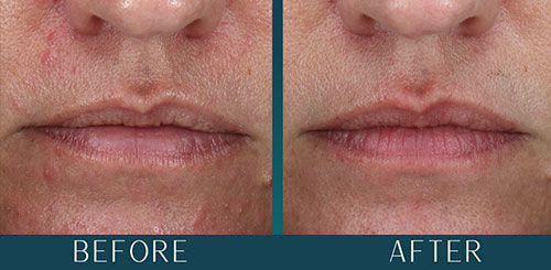 Hormonal Acne at Brickell Cosmetic Center in Miami, FL