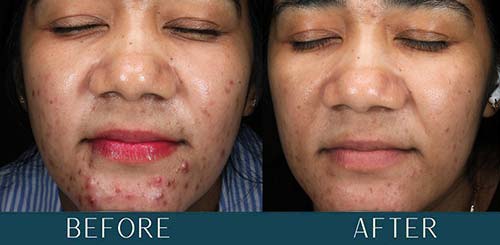 Acne Transformation at Brickell Cosmetic Center in Miami, FL Acne Transformation at Brickell Cosmetic Center in Miami, FL