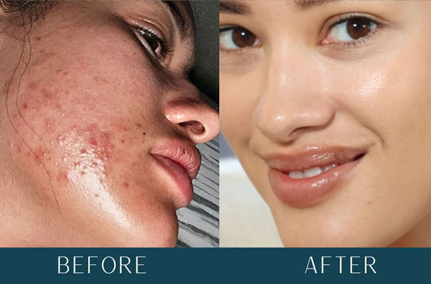 Acne Transformation at Brickell Cosmetic Center in Miami, FL Acne Transformation at Brickell Cosmetic Center in Miami, FL