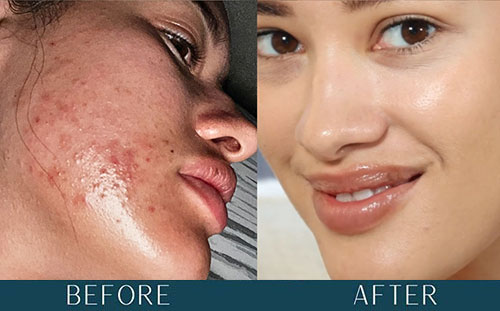 Acne Transformation at Brickell Cosmetic Center in Miami, FL