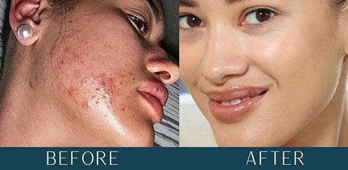 Acne Transformation at Brickell Cosmetic Center in Miami, FL Acne Transformation at Brickell Cosmetic Center in Miami, FL