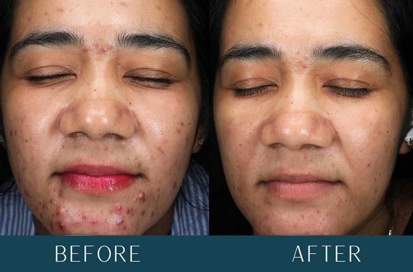 Acne Transformation at Brickell Cosmetic Center in Miami, FL Acne Transformation at Brickell Cosmetic Center in Miami, FL