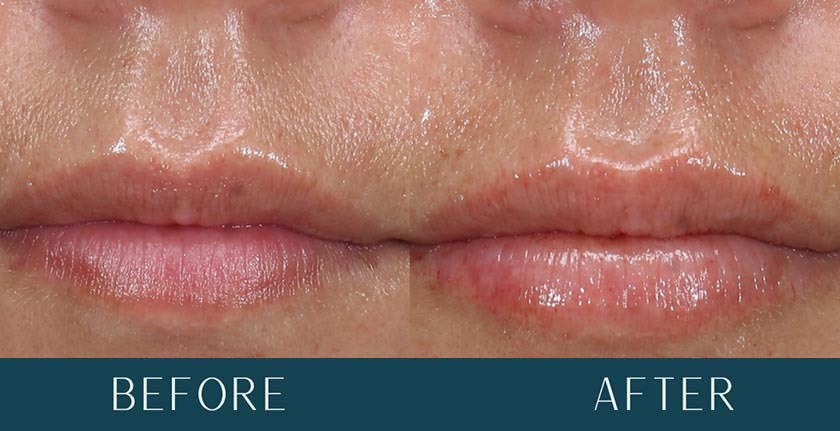 Lip Filler Enhancement at Brickell Cosmetic Center in Miami, FL