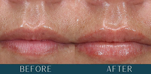 Lip Filler Enhancement at Brickell Cosmetic Center in Miami, FL