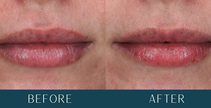 Lip Hydration Treatment at Brickell Cosmetic Center in Miami, FL
