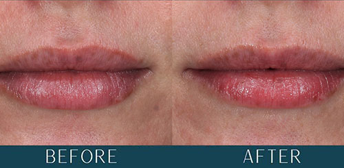 Lip Hydration Treatment at Brickell Cosmetic Center in Miami, FL