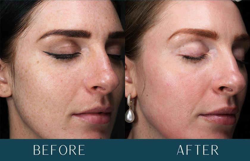 Skin Improvements at Brickell Cosmetic Center in Miami, FL