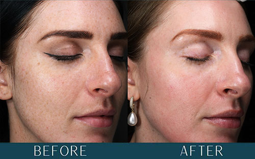 Skin Improvements at Brickell Cosmetic Center in Miami, FL