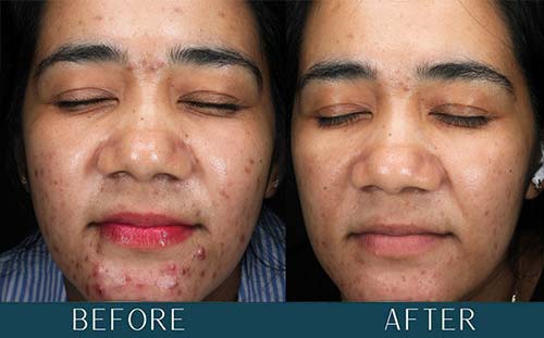 Acne Transformation at Brickell Cosmetic Center in Miami, FL