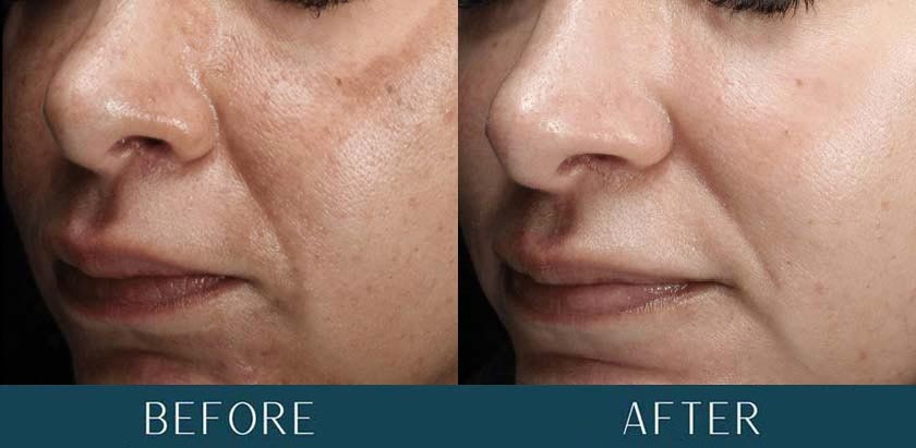 Melasma + Refractory Acne at Brickell Cosmetic Center in Miami, FL