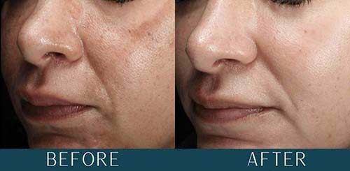 Melasma + Refractory Acne at Brickell Cosmetic Center in Miami, FL