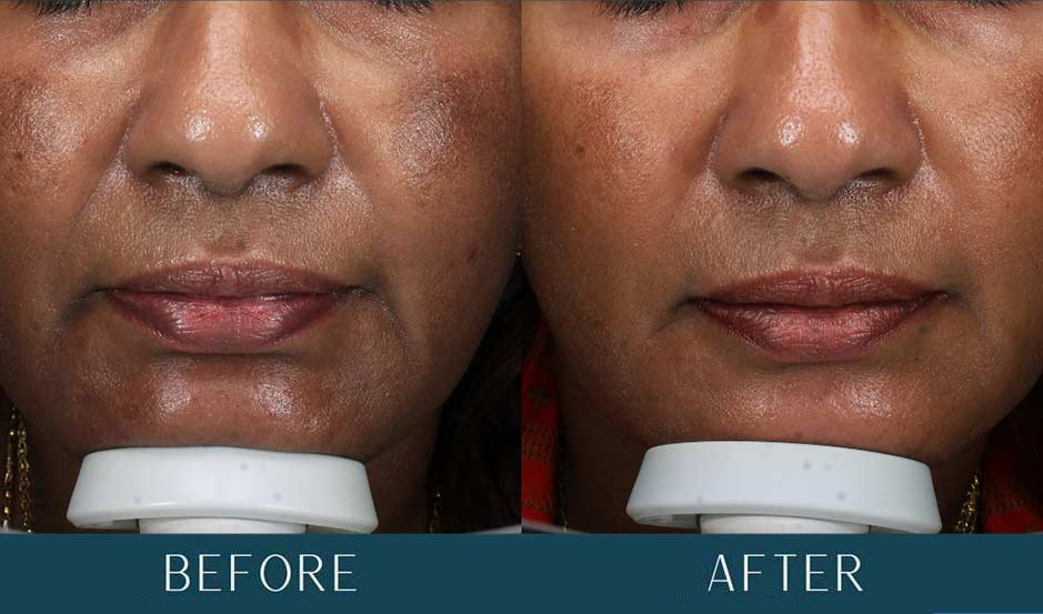 Melasma Improvements at Brickell Cosmetic Center in Miami, FL Melasma Improvements at Brickell Cosmetic Center in Miami, FL