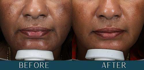 Melasma Improvements at Brickell Cosmetic Center in Miami, FL Melasma Improvements at Brickell Cosmetic Center in Miami, FL