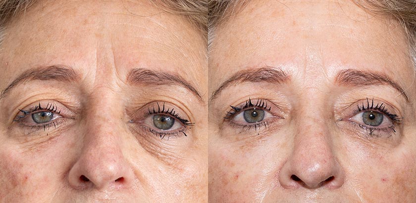 Before and After - EZGel PRF Injections Specialist in Miami, FL