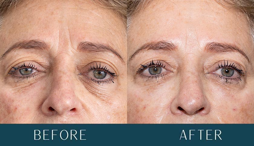 Before and After - PRF EZGel Rejuvenation at Brickell Cosmetic Center in Miami, FL
