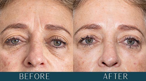 Before and After - PRF EZGel Rejuvenation at Brickell Cosmetic Center in Miami, FL