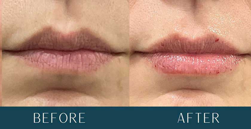 Before and After Treatment Results at Brickell Cosmetic Center in Miami, FL