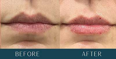 Before and After Treatment Results at Brickell Cosmetic Center in Miami, FL