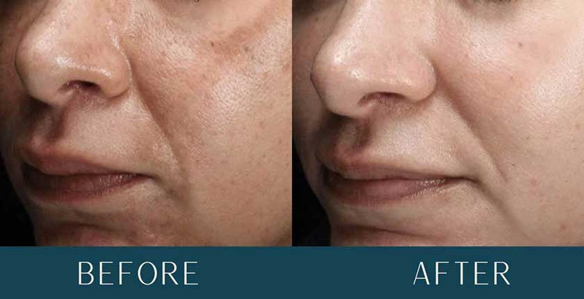 Before and After Treatment Results at Brickell Cosmetic Center in Miami, FL