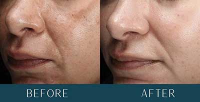 Before and After Treatment Results at Brickell Cosmetic Center in Miami, FL