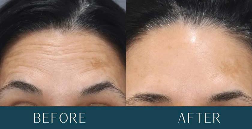 Morpheus8 Treatment Results